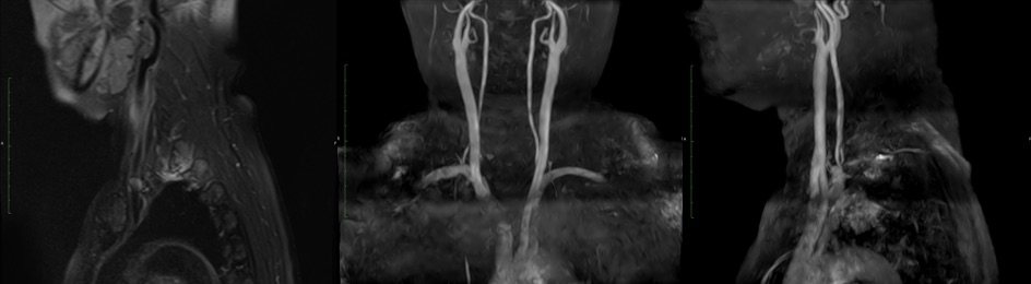 Carotidynia MRA