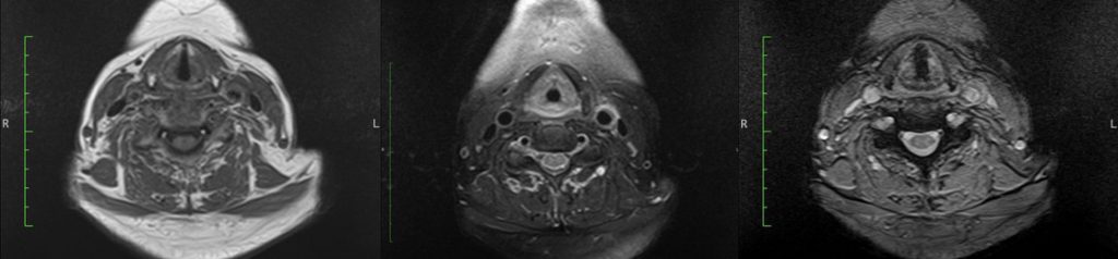 Carotidynia-MRI(no CE)