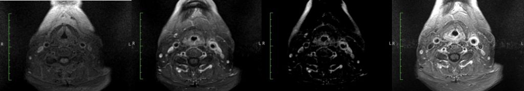 Carotidynia CEMRI