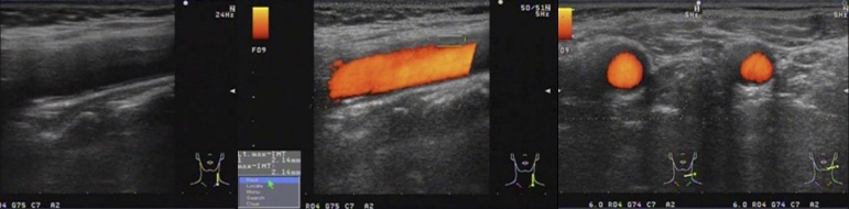 carotidynia US 2W later