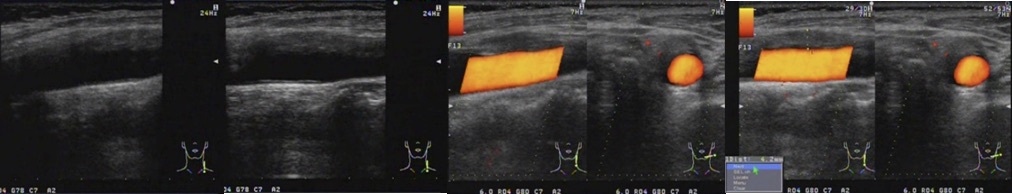 　Carotidynia US (first contact)