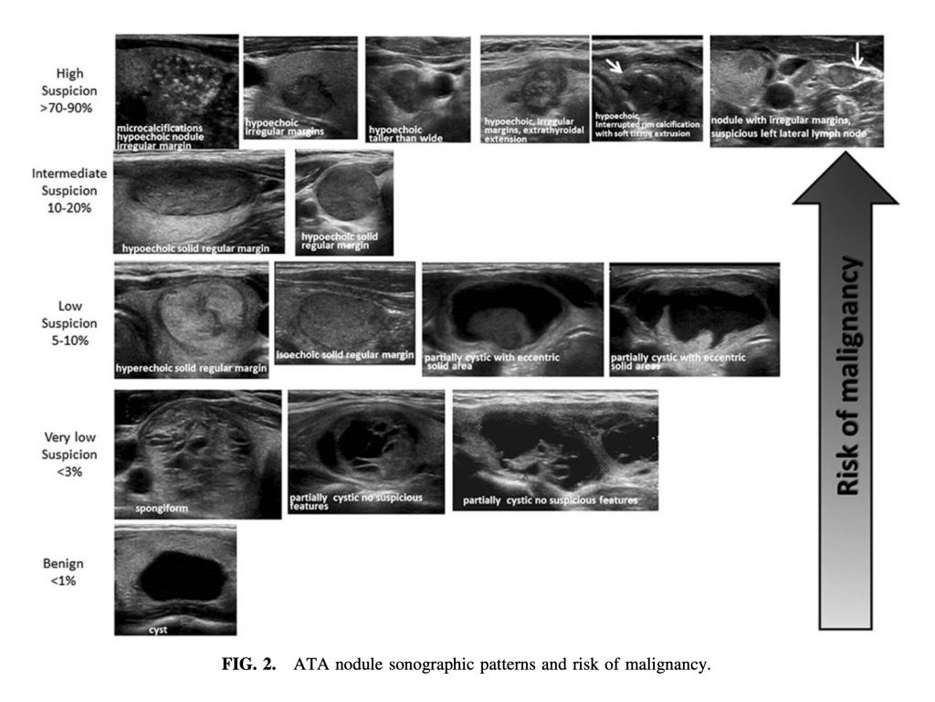 甲状腺結節のエコー分類